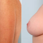 Breast Lift with Augmentation before and after photos in Houston, TX, Patient 57738