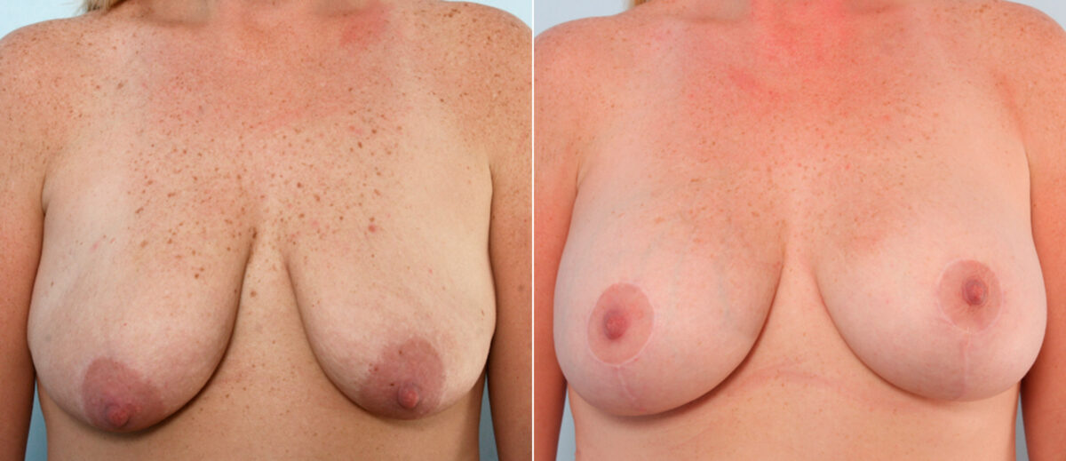 Breast Lift with Augmentation before and after photos in Houston, TX, Patient 57738