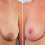 Breast Lift with Augmentation before and after photos in Houston, TX, Patient 57738