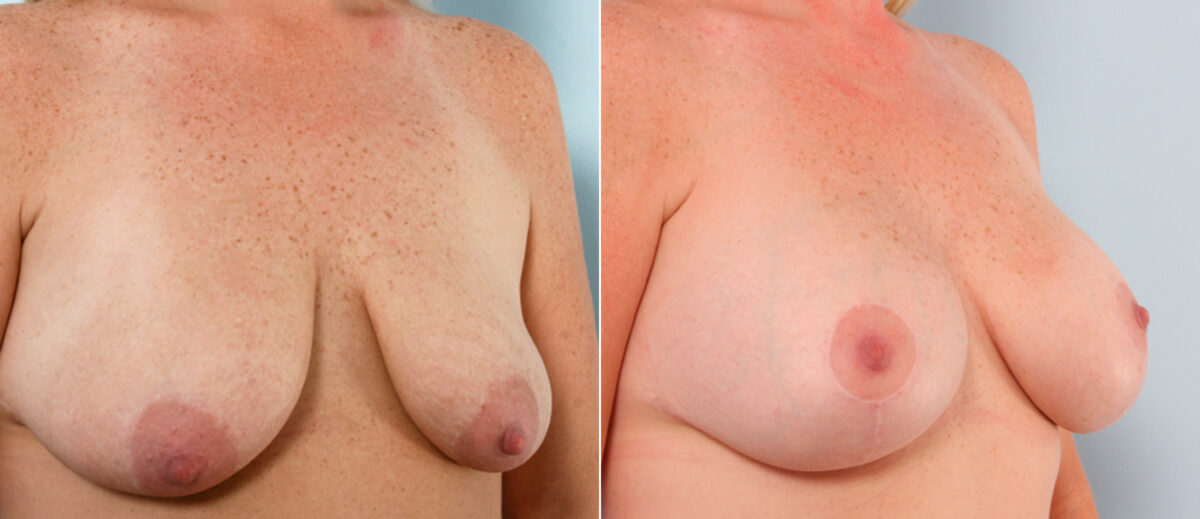 Breast Lift with Augmentation before and after photos in Houston, TX, Patient 57738