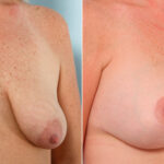 Breast Lift with Augmentation before and after photos in Houston, TX, Patient 57738
