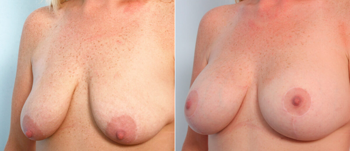 Breast Lift with Augmentation before and after photos in Houston, TX, Patient 57738