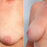 Breast Lift with Augmentation before and after photos in Houston, TX, Patient 57738