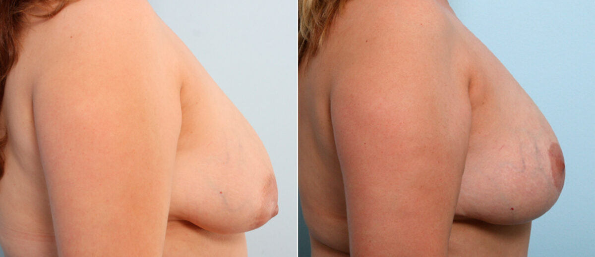 Breast Lift before and after photos in Houston, TX, Patient 57754