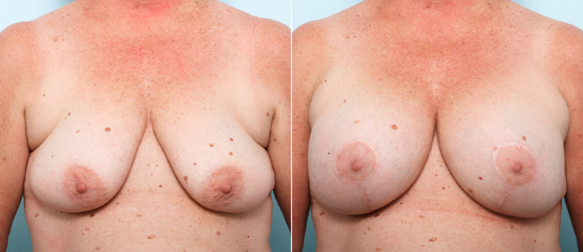 Breast Lift with Augmentation before and after photos in Houston, TX, Patient 57770
