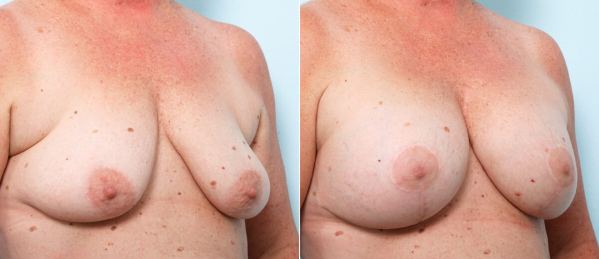 Breast Lift with Augmentation before and after photos in Houston, TX, Patient 57770