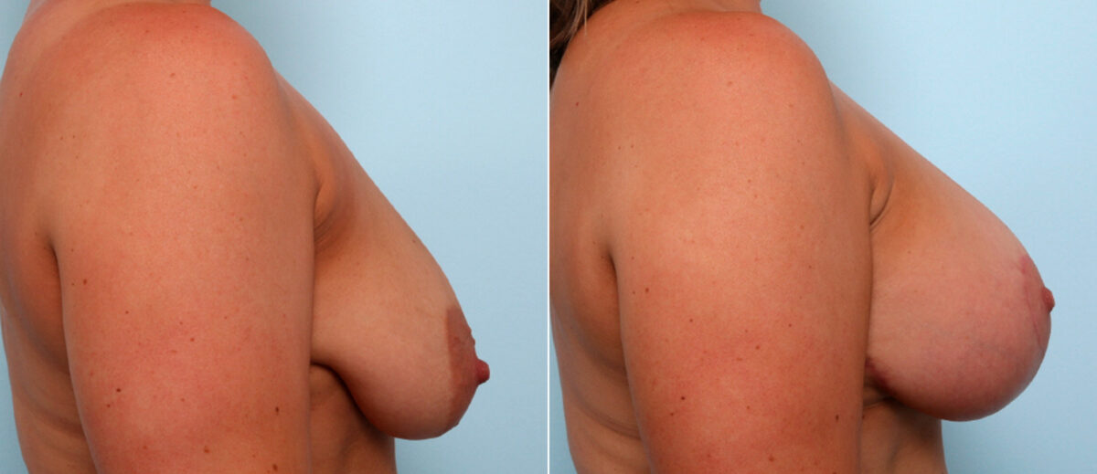 Breast Lift with Augmentation before and after photos in Houston, TX, Patient 57786