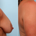 Breast Lift with Augmentation before and after photos in Houston, TX, Patient 57786