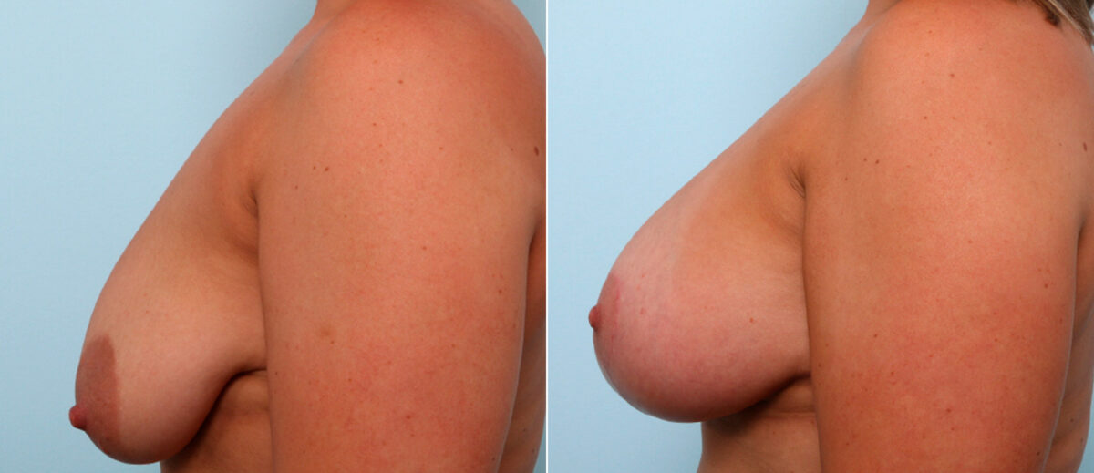 Breast Lift with Augmentation before and after photos in Houston, TX, Patient 57786