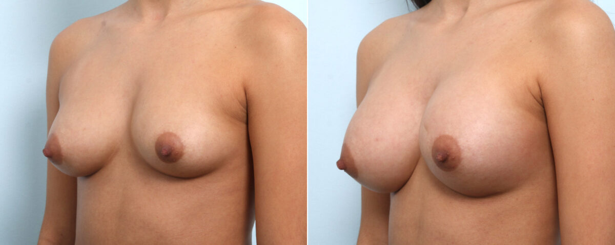 Breast Augmentation before and after photos in Houston, TX, Patient 58899