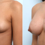 Breast Augmentation before and after photos in Houston, TX, Patient 58899