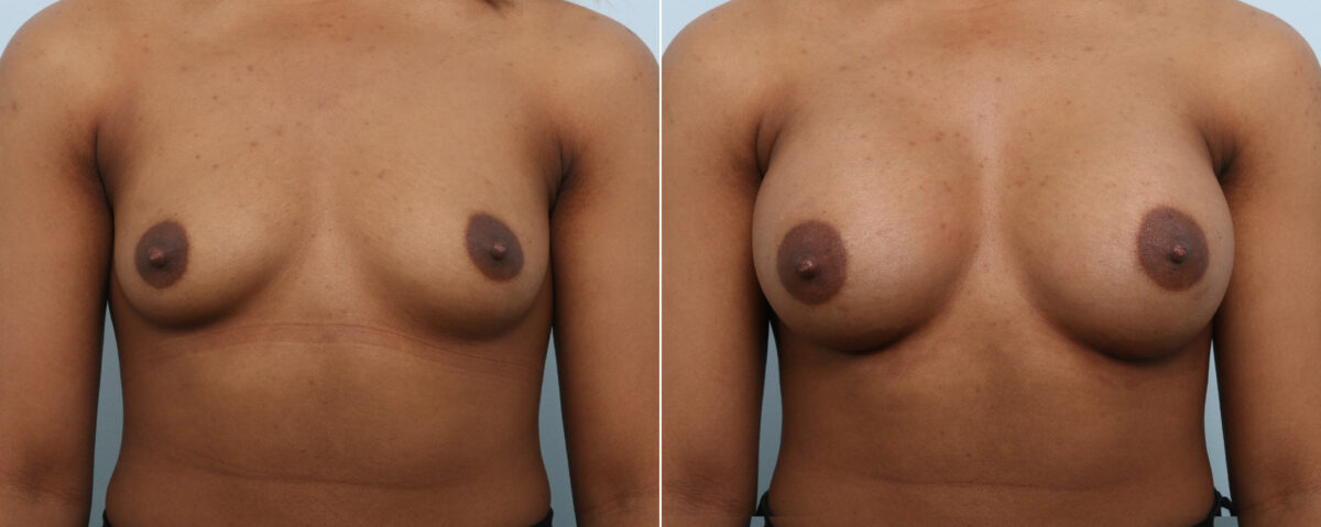Breast Augmentation before and after photos in Houston, TX, Patient 59087
