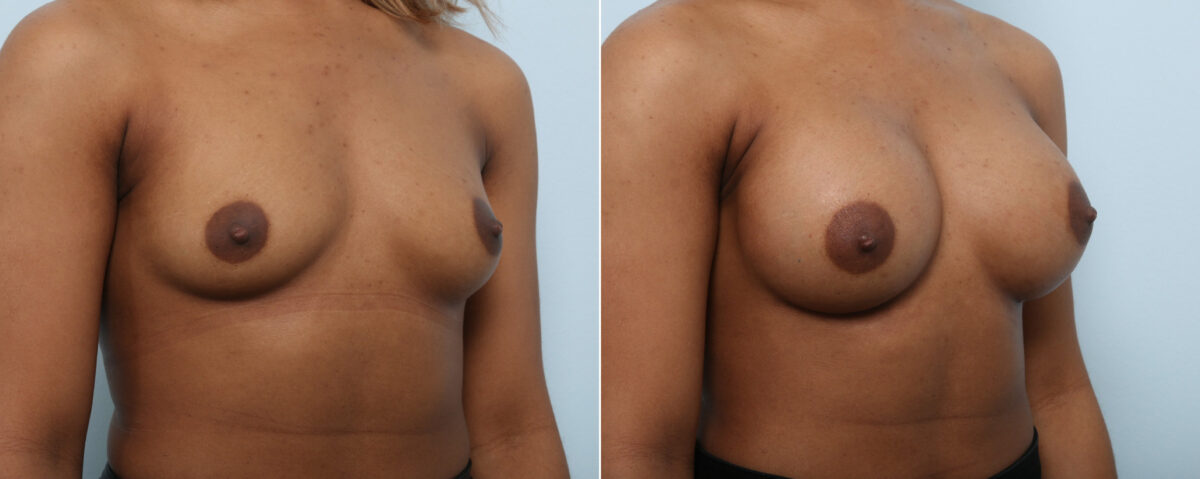 Breast Augmentation before and after photos in Houston, TX, Patient 59087
