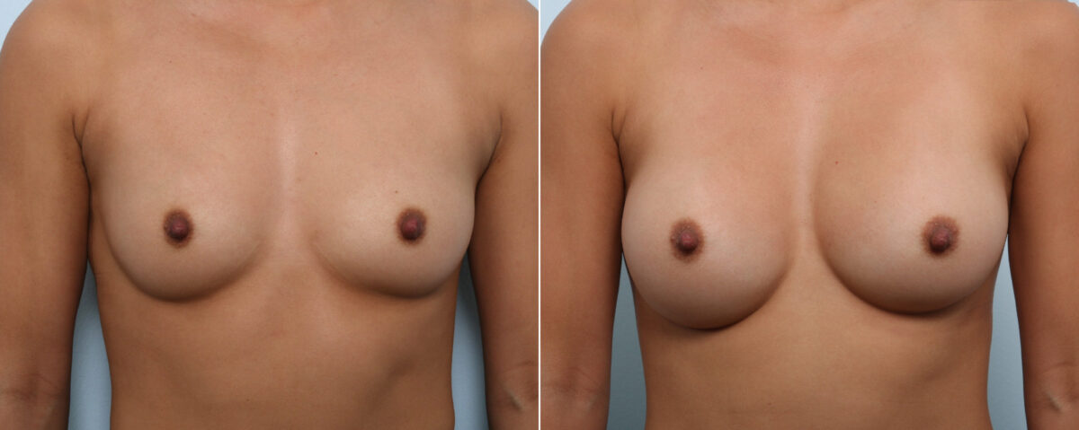 Breast Augmentation before and after photos in Houston, TX, Patient 59103