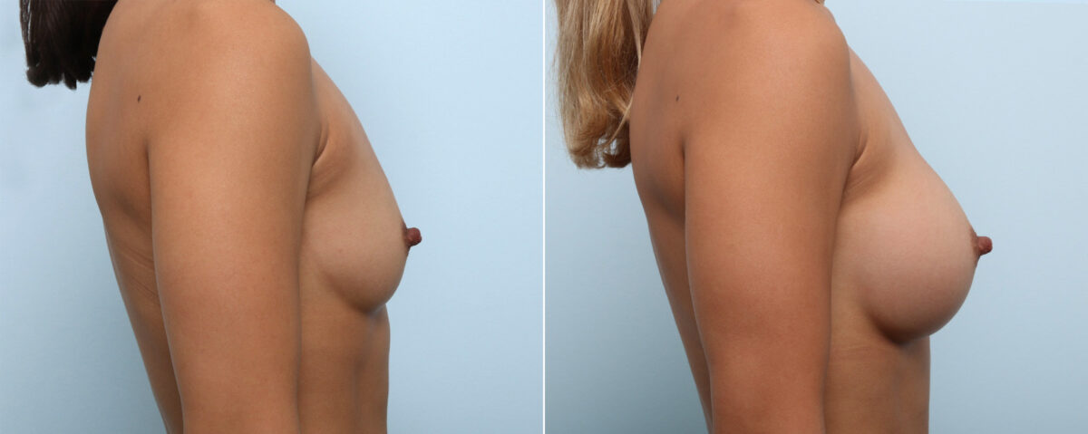 Breast Augmentation before and after photos in Houston, TX, Patient 59103