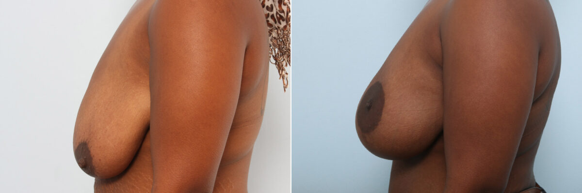 Breast Augmentation-Mastopexy before and after photos in Houston, TX, Patient 59287