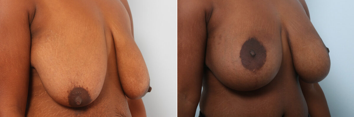 Breast Augmentation-Mastopexy before and after photos in Houston, TX, Patient 59287