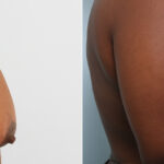 Breast Augmentation-Mastopexy before and after photos in Houston, TX, Patient 59287
