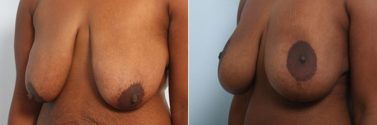 Breast Augmentation-Mastopexy before and after photos in Houston, TX, Patient 59287