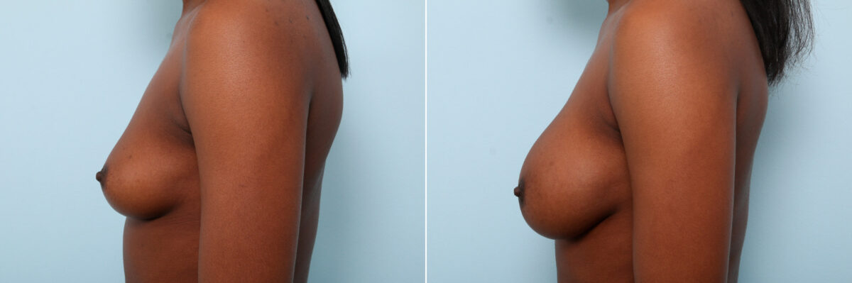Breast Augmentation before and after photos in Houston, TX, Patient 59459