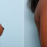 Breast Augmentation before and after photos in Houston, TX, Patient 59459