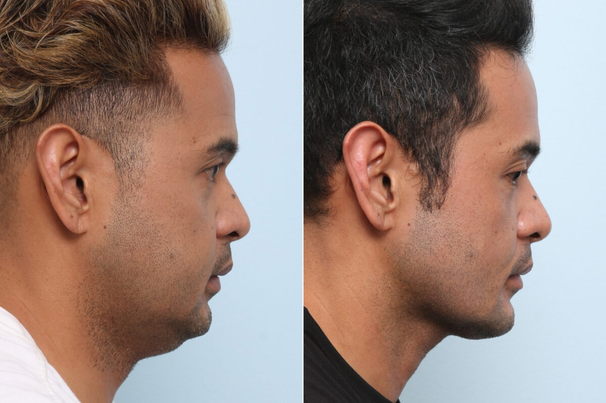 Chin Augmentation before and after photos in Houston, TX, Patient 60033