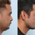 Chin Augmentation before and after photos in Houston, TX, Patient 60033