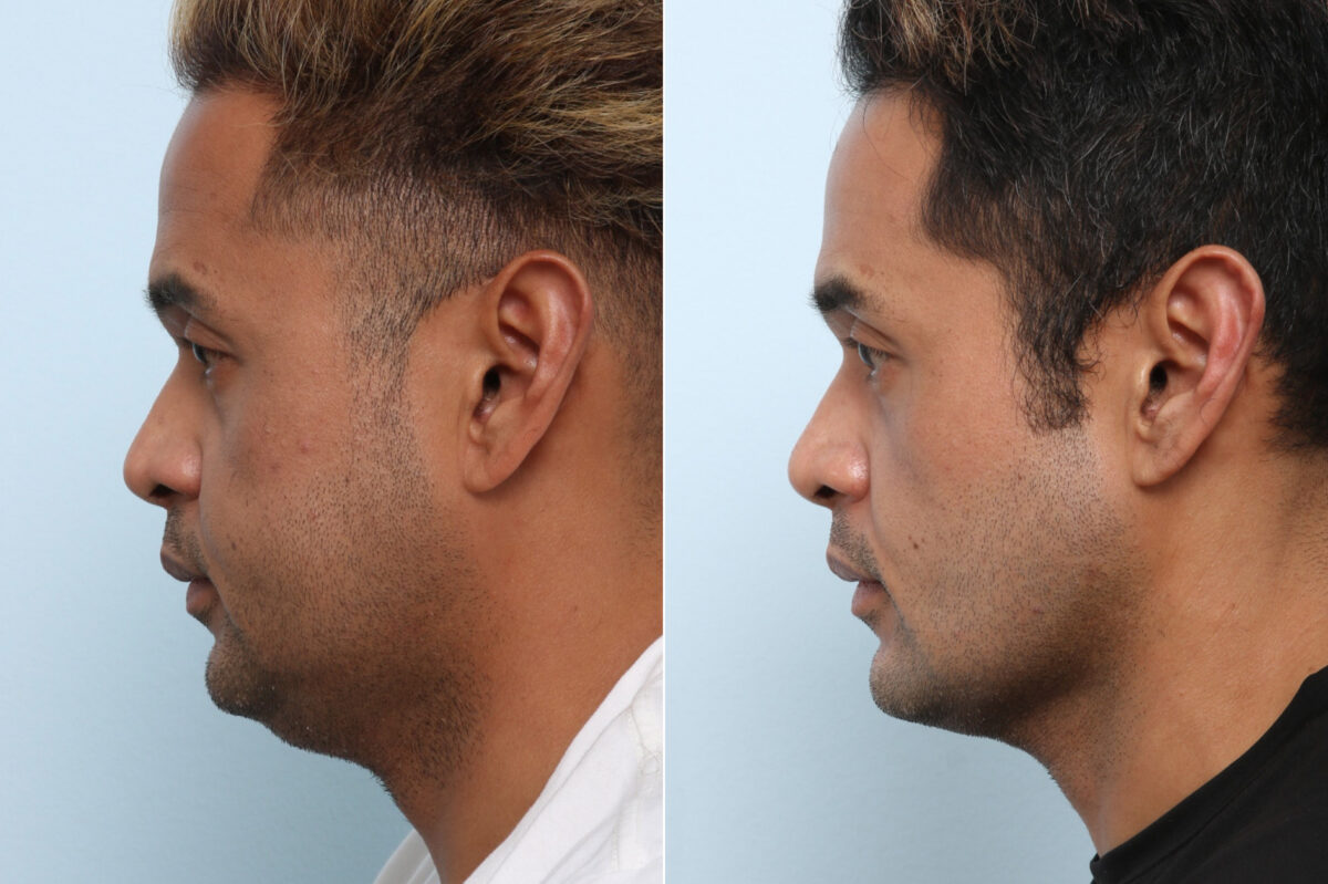 Chin Augmentation before and after photos in Houston, TX, Patient 60033