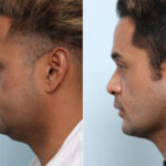 Chin Augmentation before and after photos in Houston, TX, Patient 60033