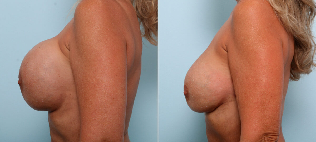 Breast Revision with Strattice before and after photos in Houston, TX, Patient 60075