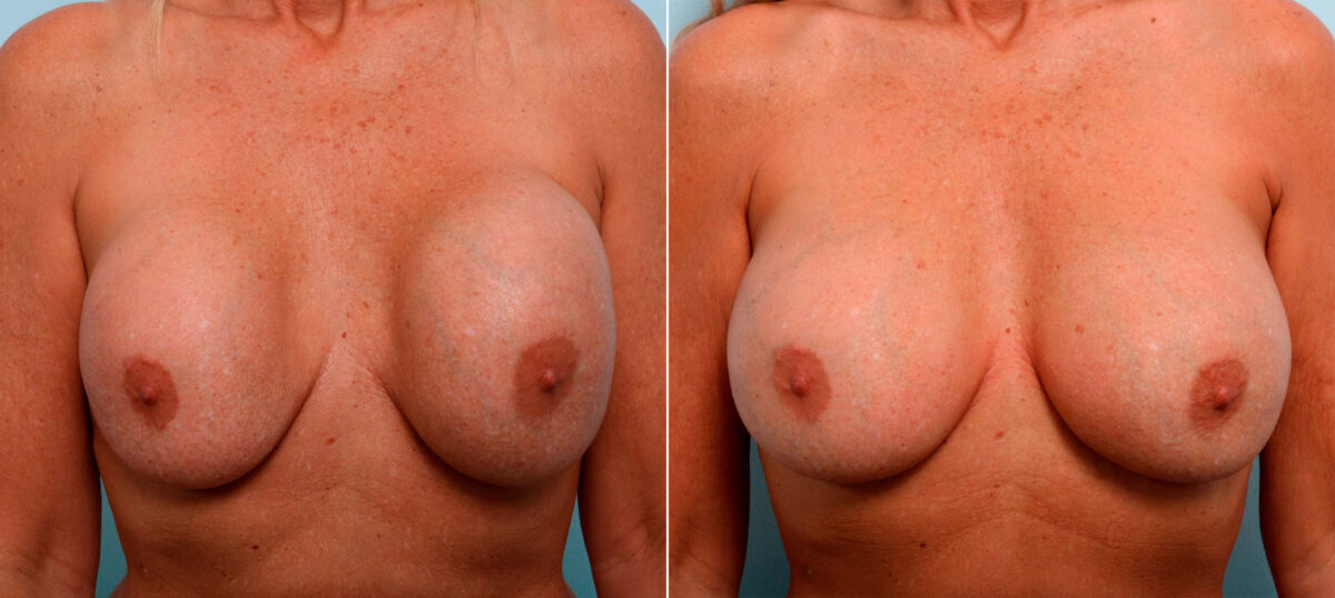 Breast Revision with Strattice before and after photos in Houston, TX, Patient 60075