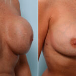 Breast Revision with Strattice before and after photos in Houston, TX, Patient 60075