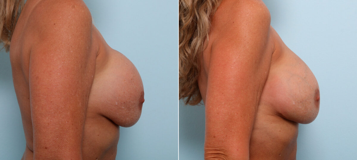 Breast Revision with Strattice before and after photos in Houston, TX, Patient 60075