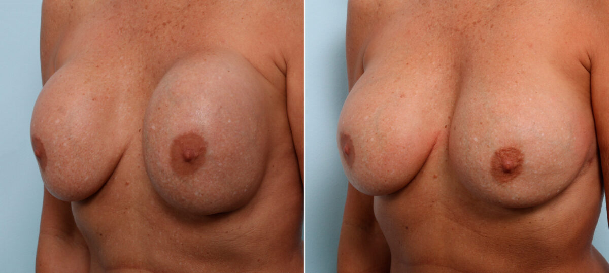 Breast Revision with Strattice before and after photos in Houston, TX, Patient 60075