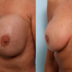 Breast Revision with Strattice before and after photos in Houston, TX, Patient 60075