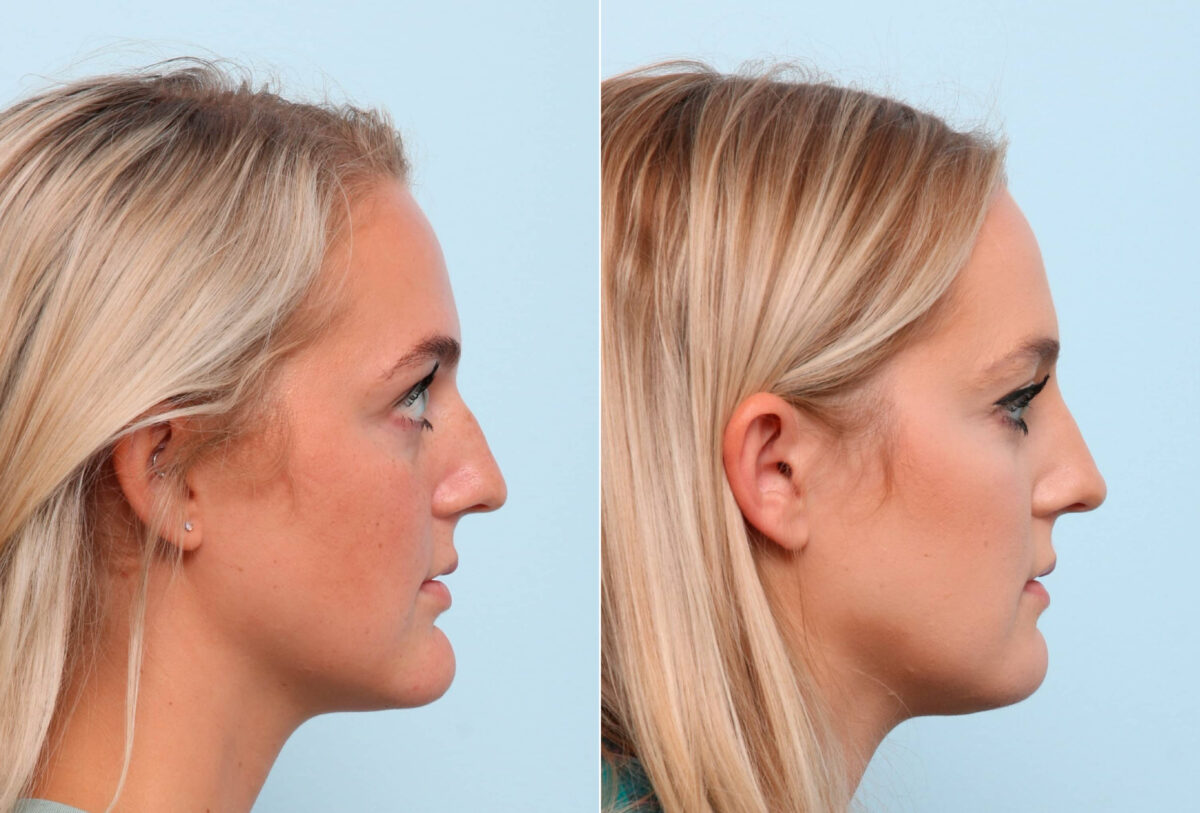 Chin Augmentation before and after photos in Houston, TX, Patient 60231