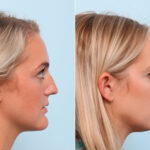 Chin Augmentation before and after photos in Houston, TX, Patient 60231