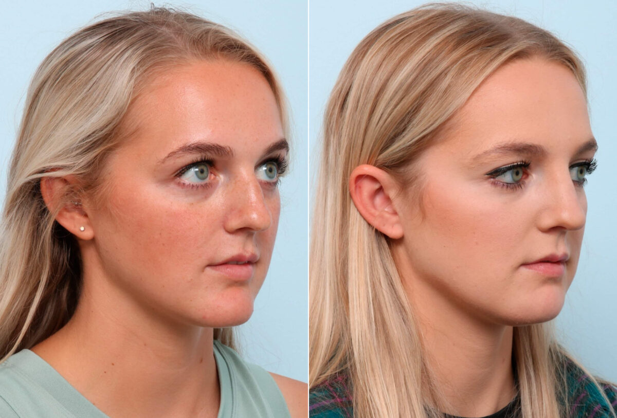 Chin Augmentation before and after photos in Houston, TX, Patient 60231