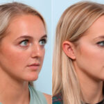 Chin Augmentation before and after photos in Houston, TX, Patient 60231