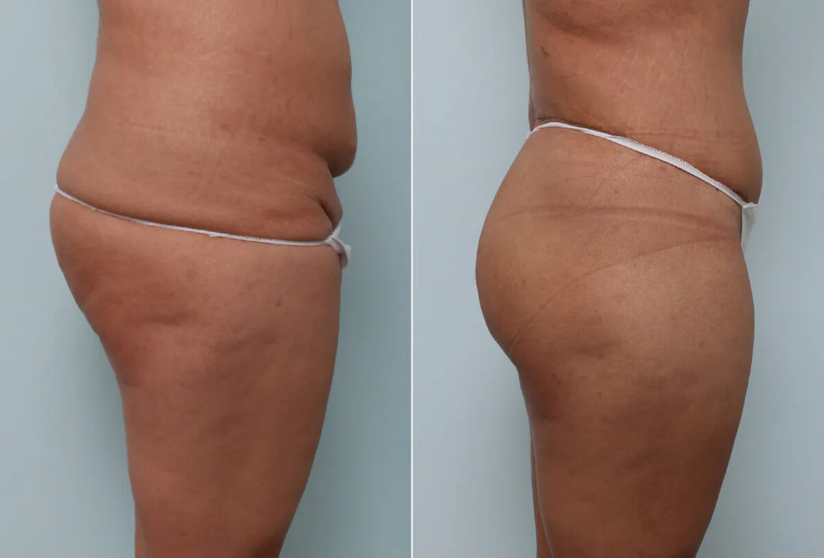 Body Lift before and after photos in Houston, TX, Patient 70565