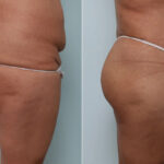 Body Lift before and after photos in Houston, TX, Patient 70565