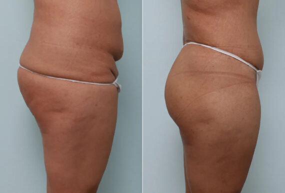 Body Lift before and after photos in Houston, TX, Patient 70565