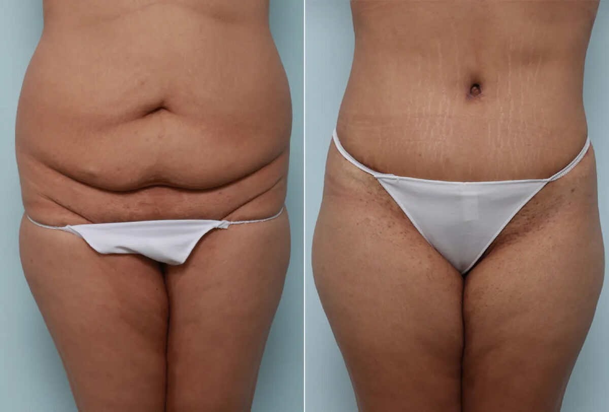 Body Lift before and after photos in Houston, TX, Patient 70565