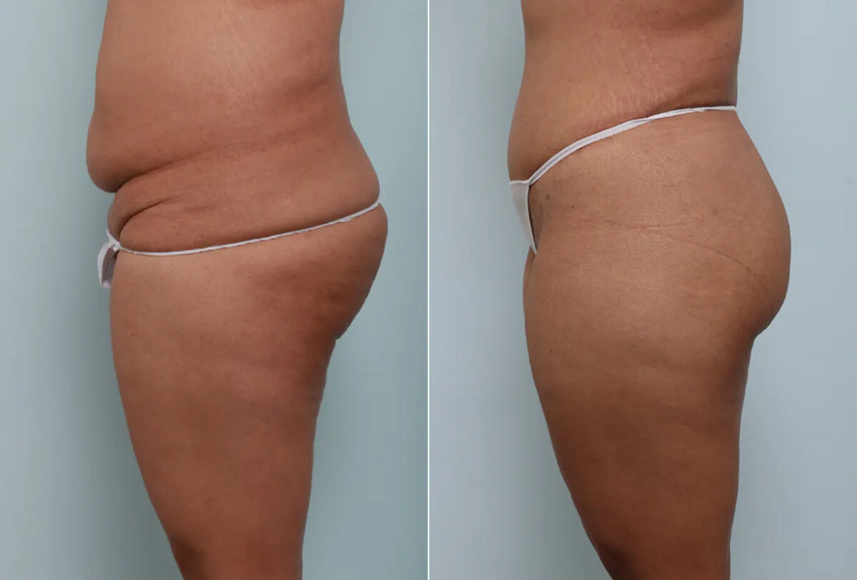 Body Lift before and after photos in Houston, TX, Patient 70565