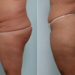 Body Lift before and after photos in Houston, TX, Patient 70565