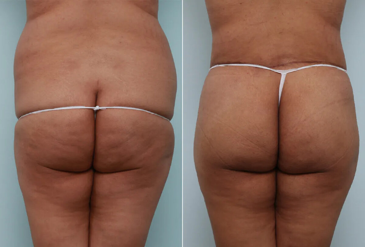 Body Lift before and after photos in Houston, TX, Patient 70565