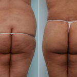 Body Lift before and after photos in Houston, TX, Patient 70565