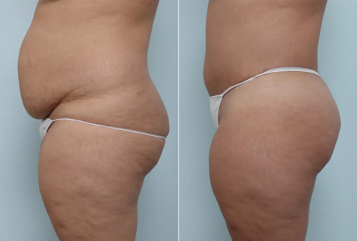 Body Lift before and after photos in Houston, TX, Patient 70580