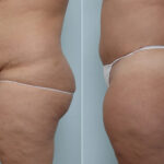 Body Lift before and after photos in Houston, TX, Patient 70580