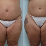 Body Lift before and after photos in Houston, TX, Patient 70580